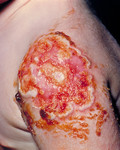 Free Picture of Child with Progressive Vaccinia on His Arm