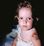 Free Picture of Kid with Progressive Vaccinia On His Arm