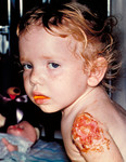 Free Picture of Boy with Progressive Vaccinia