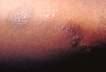 Free Picture of Patient with a Secondary Herpes Infection