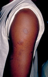 Free Picture of Person with Secondary Herpes Infection On His Arm