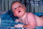 Free Picture of 8 Month Old Infant with a Widespread Rash from a Generalized Vaccinia Reaction