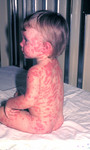 Free Picture of This Child Developed Rrythema Multiforme from a Smallpox Vaccination