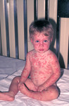 Free Picture of Child that Developed Erythema Multiforme (severe rash) from a Smallpox Vaccine