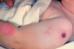 Free Picture of Child that Developed Erythema Multiforme from a Vaccination