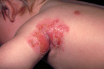 Free Picture of Child with a Secondary Infection from a Smallpox Vaccination