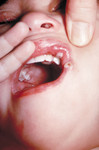 Free Picture of Child with Autoinoculation