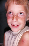 Free Picture of Child with a Case of Autoinoculation of Her Cheek after being Vaccinated with Vaccinia
