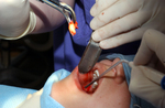 Free Picture of Tooth Extraction