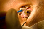 Free Picture of LASIK Surgery
