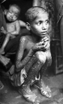 Free Picture of Kid with Smallpox Disease