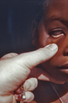 Free Picture of CDC EIS Officer Examining the Palpebral Conjunctiva of a Nigerian Child with Anemia Symptoms