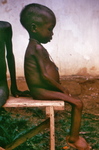 Free Picture of Child with Kwashiorkor Disease from Severe Dietary Protein Deficiency