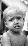 Free Picture of Child Infetcted with the Smallpox Disease