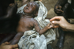 Free Picture of Nigerian Child Suffering From Smallpox During the Biafran War