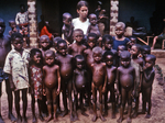 Free Picture of Nurse Standing with a Group of African Children Showing Symptoms of the Protein-Deficiency Disease Kwashiorkor