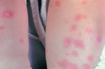 Erythema Multiforme on the Legs of a Child
